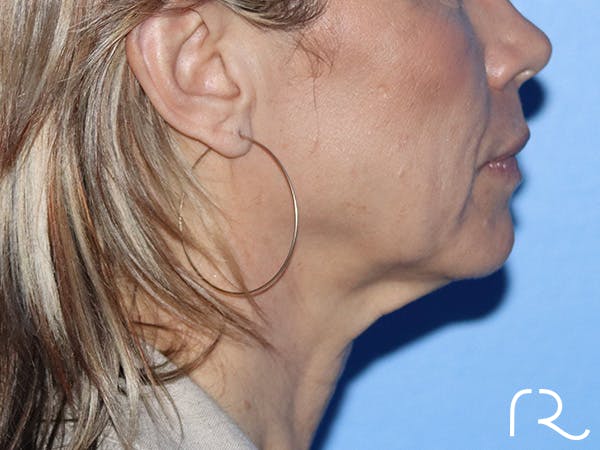 Facelift Before & After Gallery - Patient 149260164 - Image 3