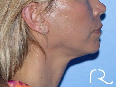 Facelift Before & After Gallery - Patient 149260164 - Image 4