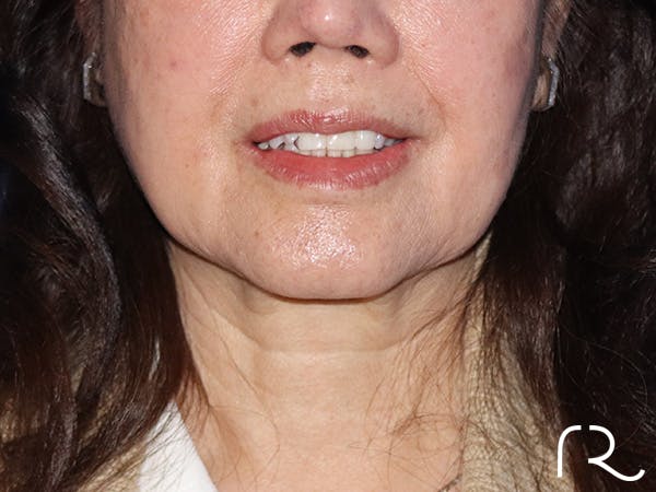 Neck Lift Before & After Gallery - Patient 149260166 - Image 5
