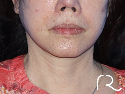 Facelift Before & After Gallery - Patient 149260165 - Image 4