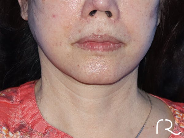Facelift Before & After Gallery - Patient 149260165 - Image 4