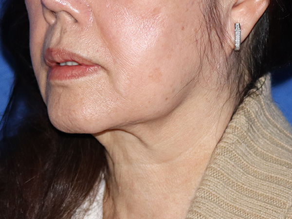 Neck Lift Before & After Gallery - Patient 149260166 - Image 1