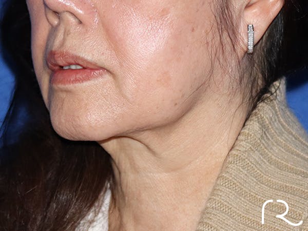 Neck Lift Before & After Gallery - Patient 149260166 - Image 1