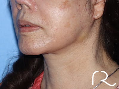 Facelift Before & After Gallery - Patient 149260165 - Image 2
