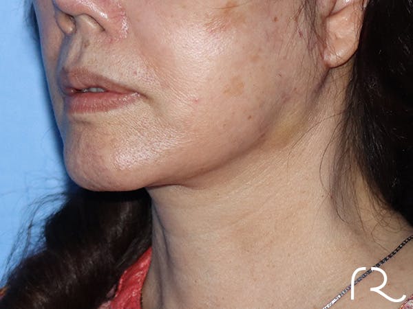 Neck Lift Before & After Gallery - Patient 149260166 - Image 2