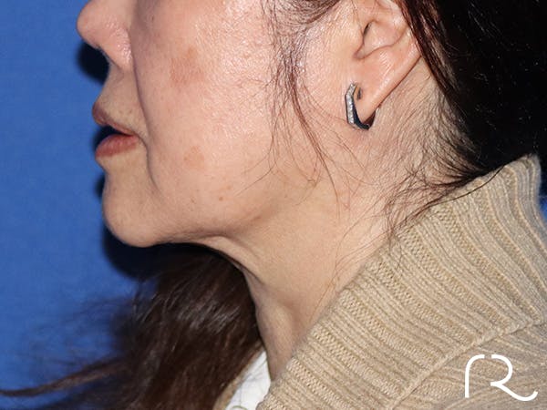 Neck Lift Before & After Gallery - Patient 149260166 - Image 3
