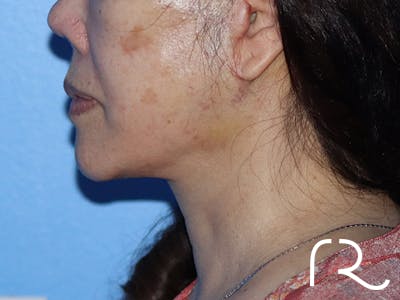 Neck Lift Before & After Gallery - Patient 149260166 - Image 4