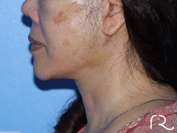 Facelift Before & After Gallery - Patient 149260165 - Image 6