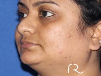 Rhinoplasty Before & After Gallery - Patient 149260169 - Image 1