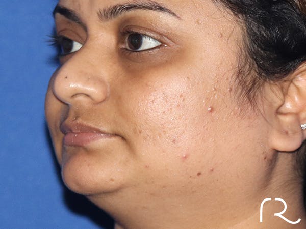 Rhinoplasty Before & After Gallery - Patient 149260169 - Image 1