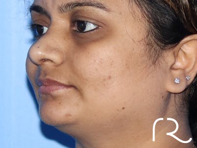 Rhinoplasty Before & After Gallery - Patient 149260169 - Image 2