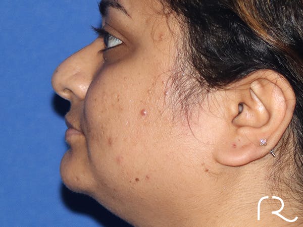 Rhinoplasty Before & After Gallery - Patient 149260169 - Image 3