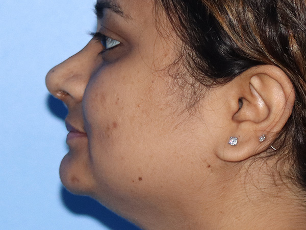 Rhinoplasty Before & After Gallery - Patient 149260169 - Image 4