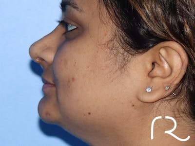 Rhinoplasty Before & After Gallery - Patient 149260169 - Image 4