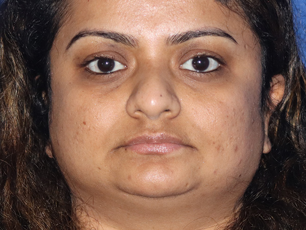 Rhinoplasty Before & After Gallery - Patient 149260169 - Image 5