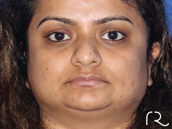 Rhinoplasty Before & After Gallery - Patient 149260169 - Image 5