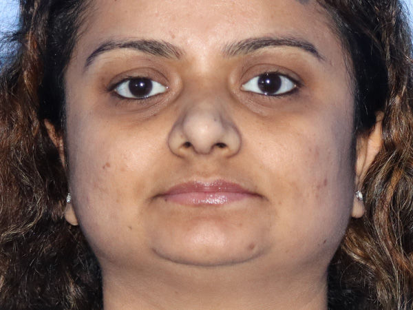 Rhinoplasty Before & After Gallery - Patient 149260169 - Image 6