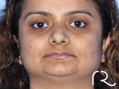 Rhinoplasty Before & After Gallery - Patient 149260169 - Image 6