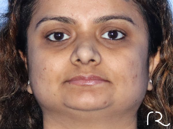 Rhinoplasty Before & After Gallery - Patient 149260169 - Image 6