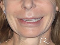 Lip Lift Before & After Gallery - Patient 149260179 - Image 1