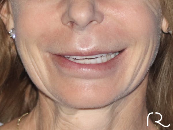 Lip Lift Before & After Gallery - Patient 149260179 - Image 1