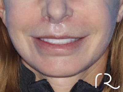 Lip Lift Before & After Gallery - Patient 149260179 - Image 2
