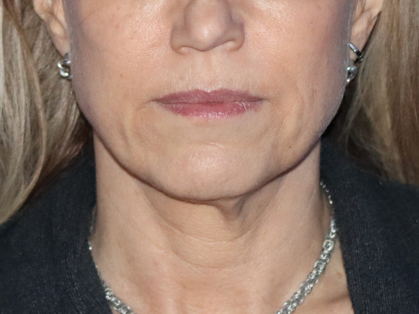 Neck Lift Before & After Gallery - Patient 149260189 - Image 5