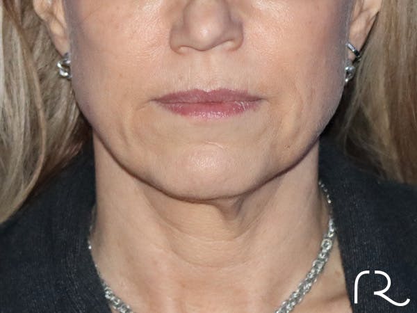 Neck Lift Before & After Gallery - Patient 149260189 - Image 5
