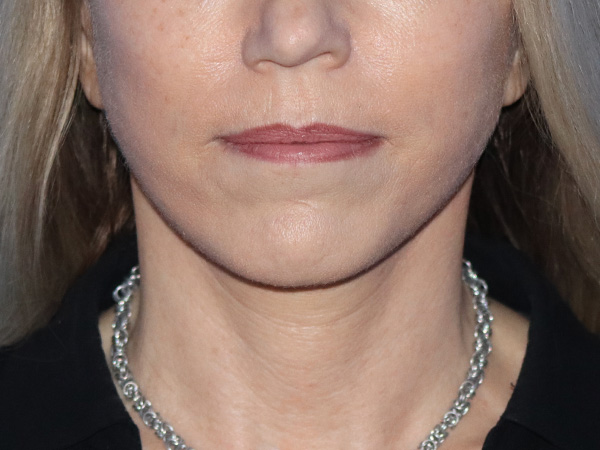 Neck Lift Before & After Gallery - Patient 149260189 - Image 6