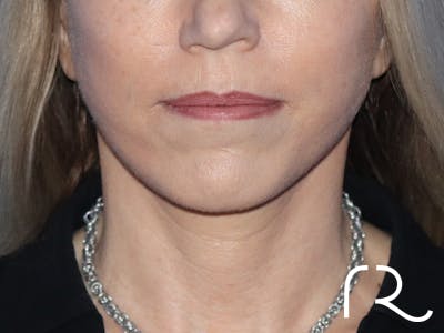 Neck Lift Before & After Gallery - Patient 149260189 - Image 6