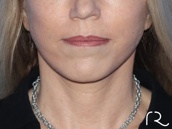 Facelift Before & After Gallery - Patient 149260182 - Image 6