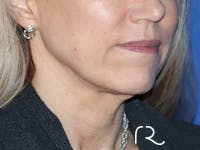 Facelift Before & After Gallery - Patient 149260182 - Image 1