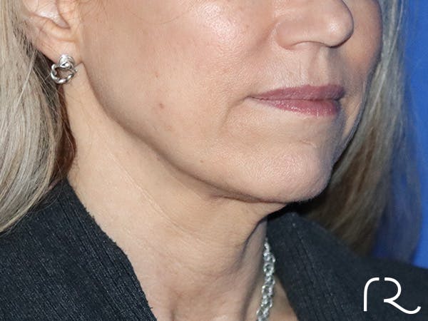 Neck Lift Before & After Gallery - Patient 149260189 - Image 1