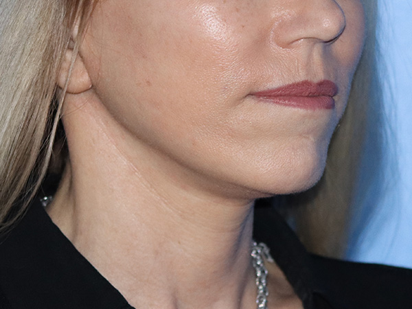 Neck Lift Before & After Gallery - Patient 149260189 - Image 2