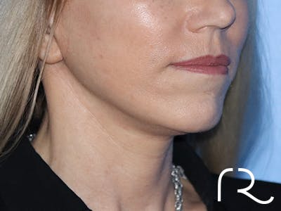 Facelift Before & After Gallery - Patient 149260182 - Image 2