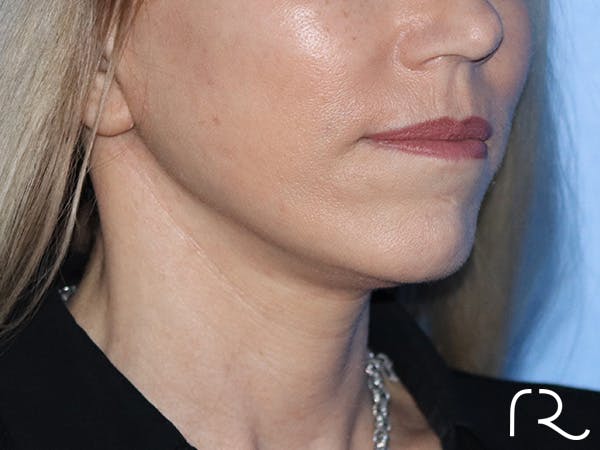 Neck Lift Before & After Gallery - Patient 149260189 - Image 2