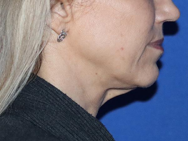 Neck Lift Before & After Gallery - Patient 149260189 - Image 3