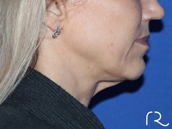 Facelift Before & After Gallery - Patient 149260182 - Image 3