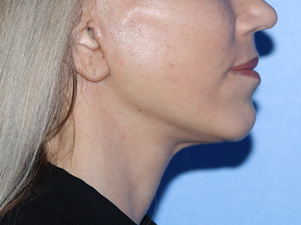 Neck Lift Before & After Gallery - Patient 149260189 - Image 4