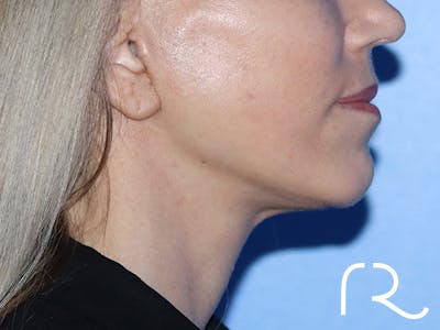 Neck Lift Before & After Gallery - Patient 149260189 - Image 4