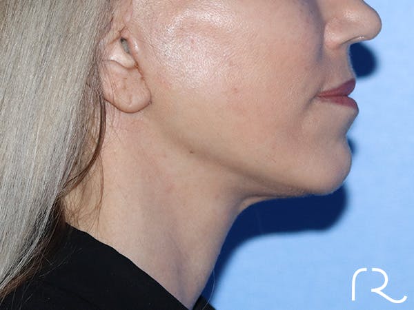 Neck Lift Before & After Gallery - Patient 149260189 - Image 4