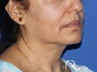 Neck Lift Before & After Gallery - Patient 149260192 - Image 1