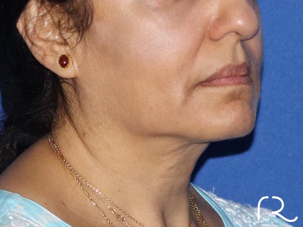 Facelift Before & After Gallery - Patient 149260194 - Image 1