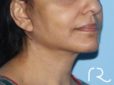 Facelift Before & After Gallery - Patient 149260194 - Image 2