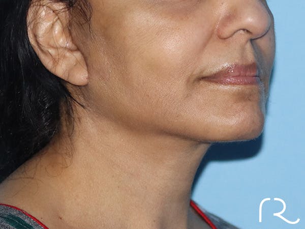 Facelift Before & After Gallery - Patient 149260194 - Image 2