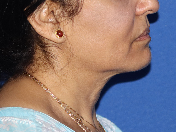 Facelift Before & After Gallery - Patient 149260194 - Image 3