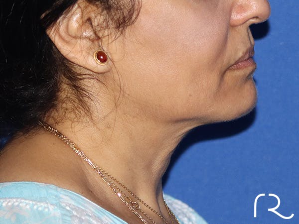 Neck Lift Before & After Gallery - Patient 149260192 - Image 3