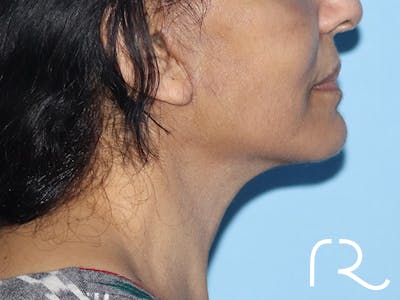 Neck Lift Before & After Gallery - Patient 149260192 - Image 4
