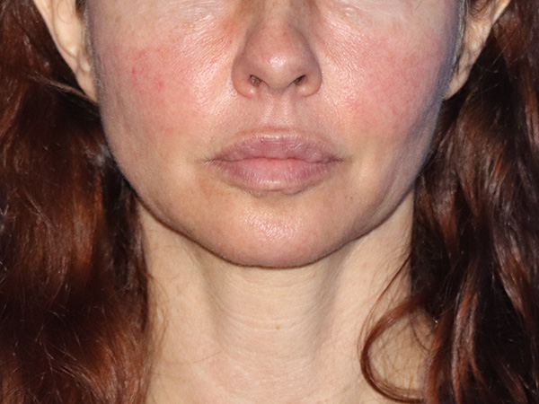 Neck Lift Before & After Gallery - Patient 149260196 - Image 5
