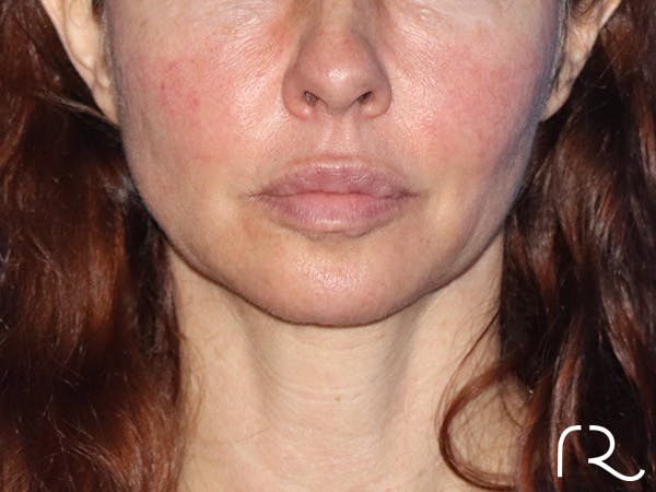 Facelift Before & After Gallery - Patient 149260195 - Image 3